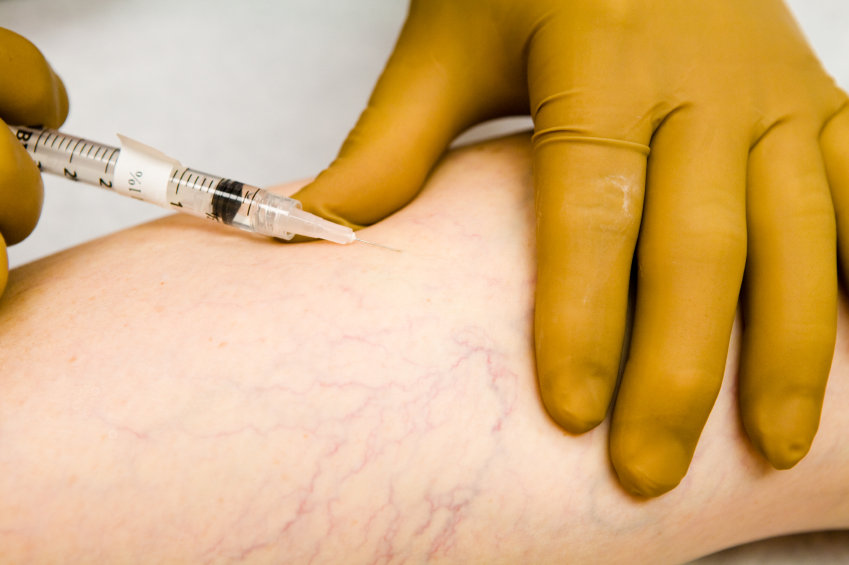 Varicose Veins Surgery (ការវះកាត់ជំងឺសរសៃឈាមវ៉ែនរីកធំ)