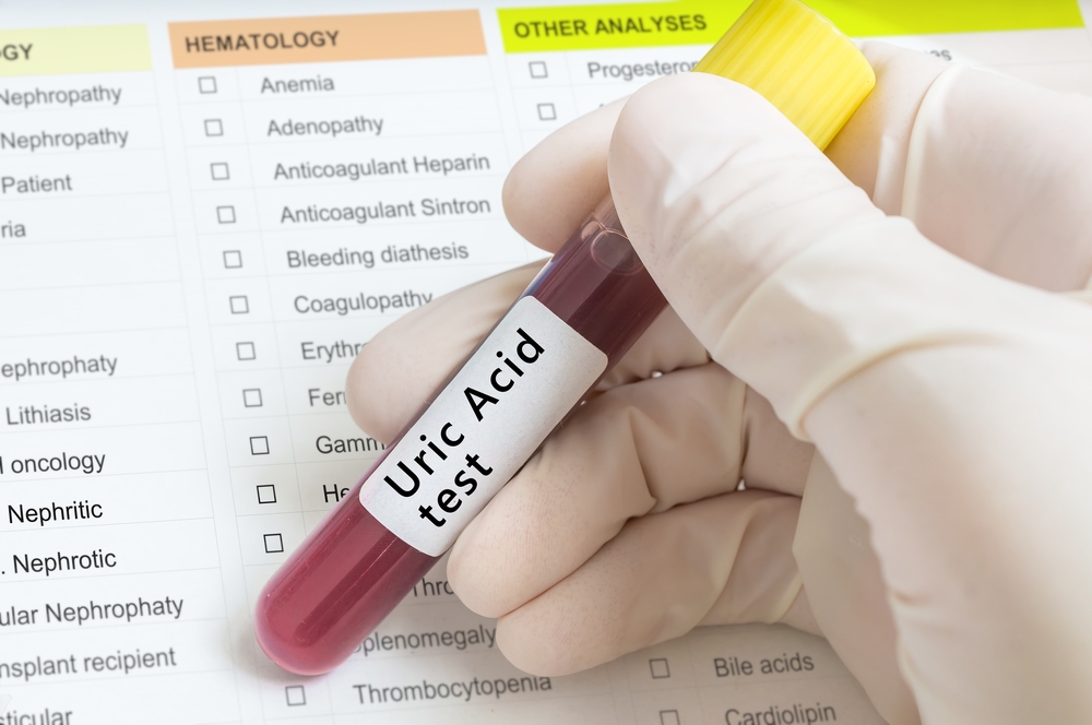 Uric Acid Blood Test (តេស្តអាស៊ីដអ៊ុយរិកក្នុងឈាម)
