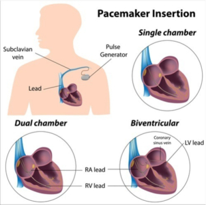 Pacemaker Insertion (វះកាត់ដាក់ថ្មបេះដូង)