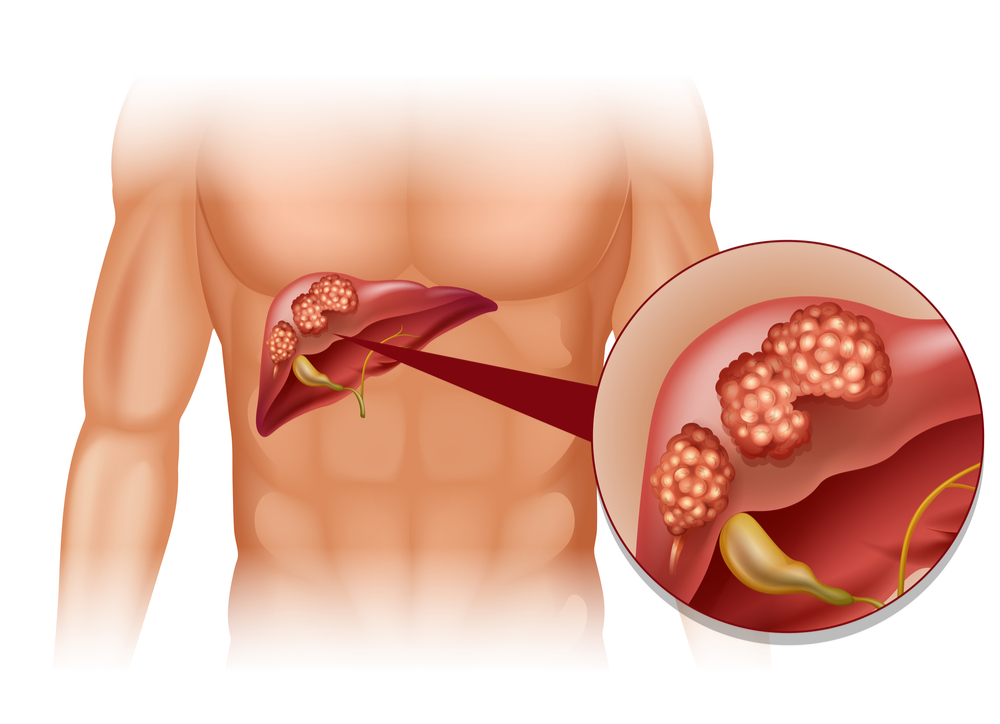 Liver Cancer (មហារីកថ្លើម)