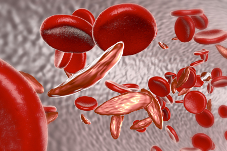 Sickle Cell Anemia (ជំងឺស្លេកស្លាំងកោសិកាឈាមក្រហមរាងកូចកណ្តៀវ)