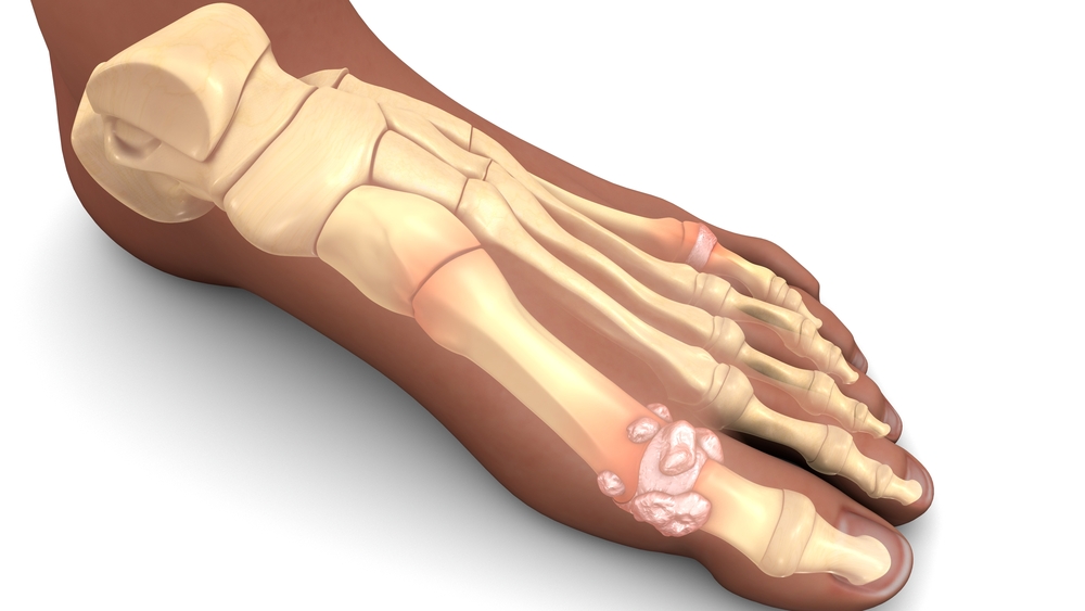 Hyperuricemia (លើសអាស៊ីដអ៊ុយរិកក្នុងឈាម)