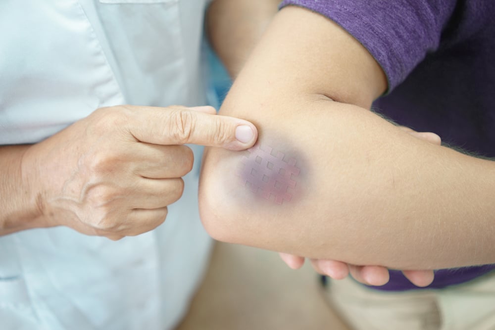 Hematoma (ដុំឈាមកក)