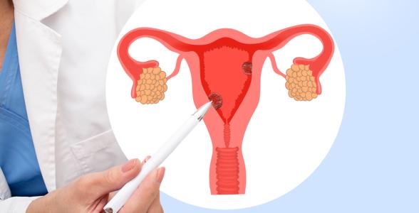 ស្វែងយល់លម្អិតពីEndometrial cancer​ (ជំងឺមហារីកស្រទាប់ក្នុងស្បូន)