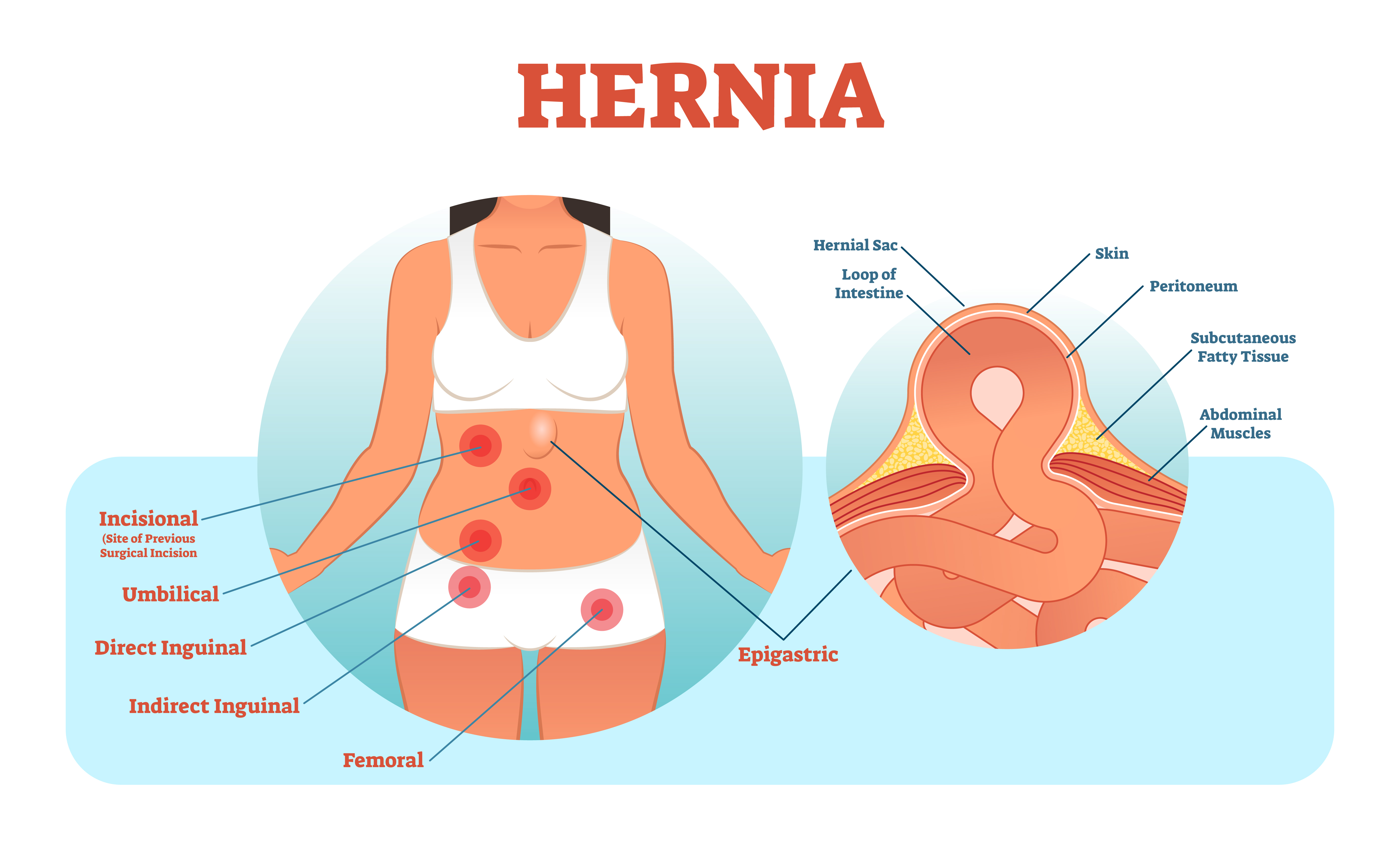 Open Incisional Hernia Repair (ការ​វះកាត់​ក្លន​ពោះវៀន​)