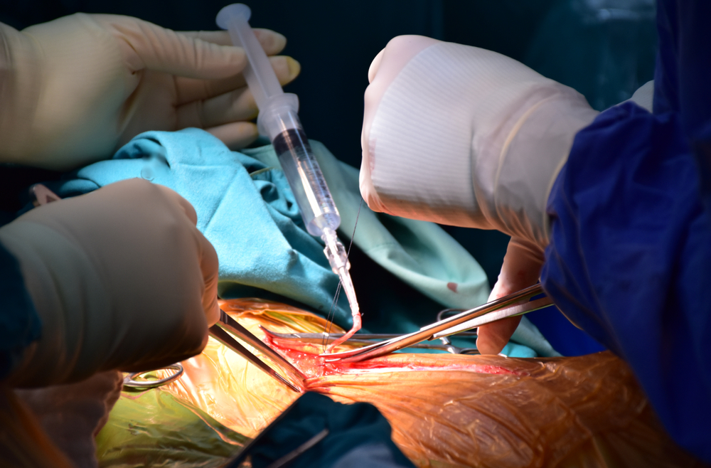 Coronary Artery Bypass Surgery (ការ​វះ​ត​ផ្លូវ​កាត់សរសៃ​អាកទែកូរ៉ូនែ)