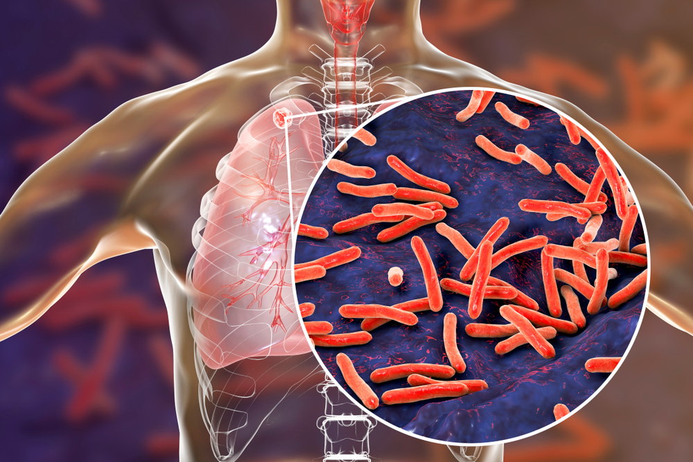 Pulmonary Tuberculosis (ជំងឺរបេងសួត)