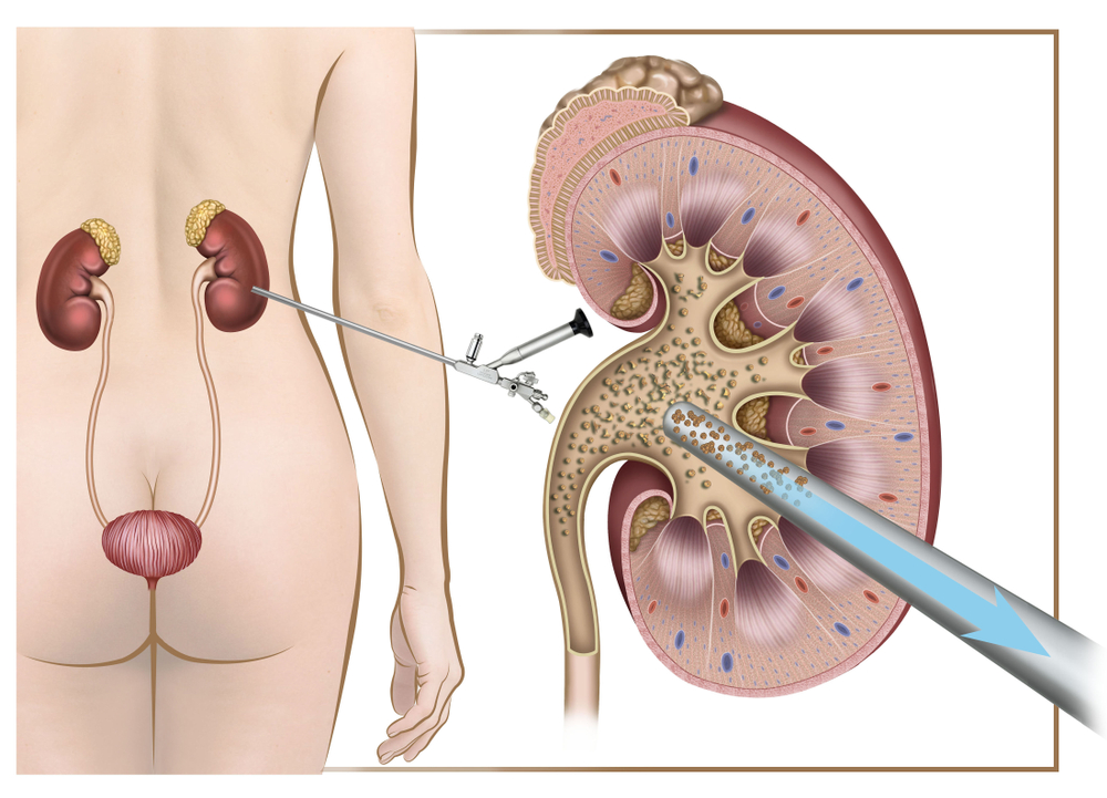 Renal Colic (បញ្ហាចុកតម្រងនោម)