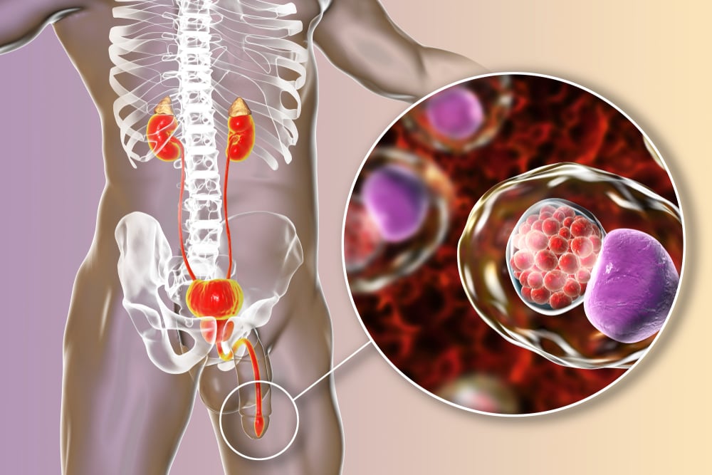 Urethral Stricture (ត្បៀតបំពង់បង្ហូរទឹកនោម)