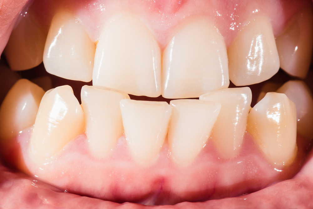 Malocclusion of the Teeth (ធ្មេញ​ដុះមិន​ត្រង់​ជួរ)
