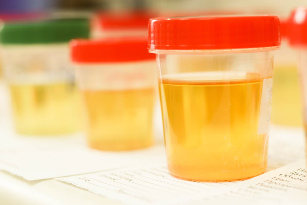 Urine color (បញ្ហាប្តូរពណ៌ទឹកនោម)