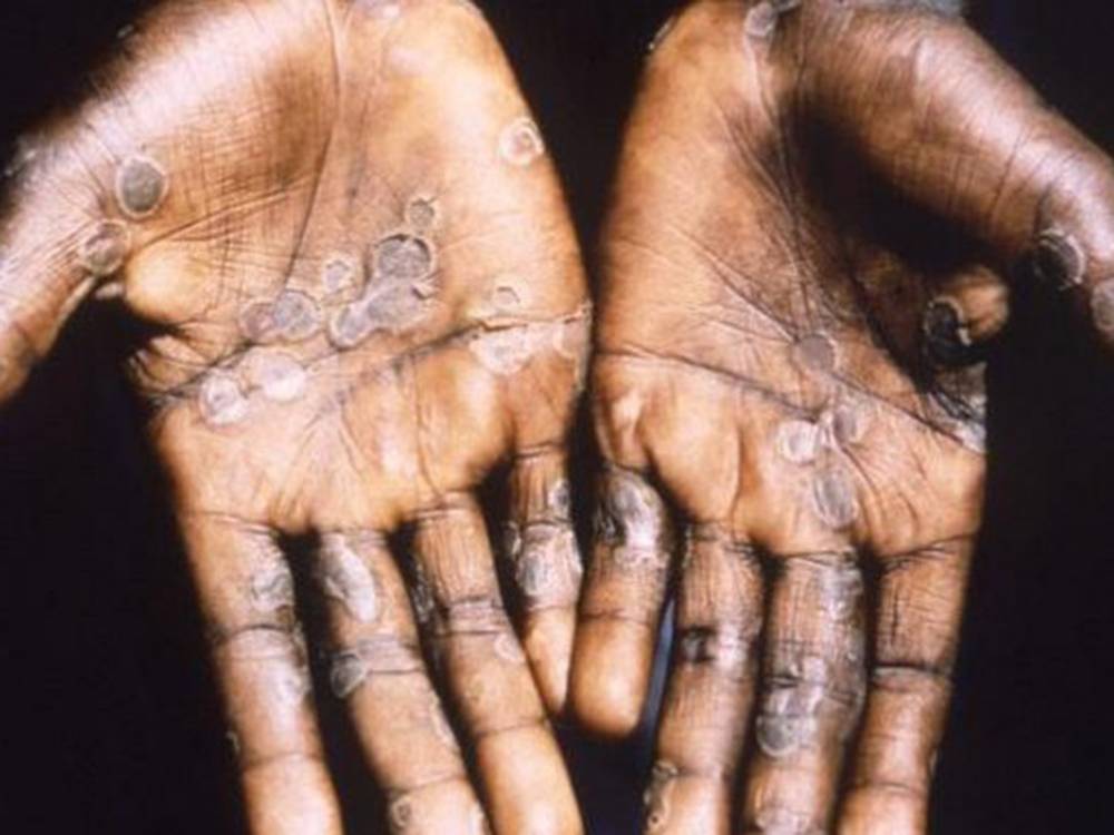 ជំងឺ Monkeypox កើត​ជាលើកដំបូងនៅ​សិង្ហបុរី អ្នក​ស្និទ្ធនឹង​អ្នក​ជំងឺត្រូវ​ឲ្យ​នៅ​តែ​ឯង