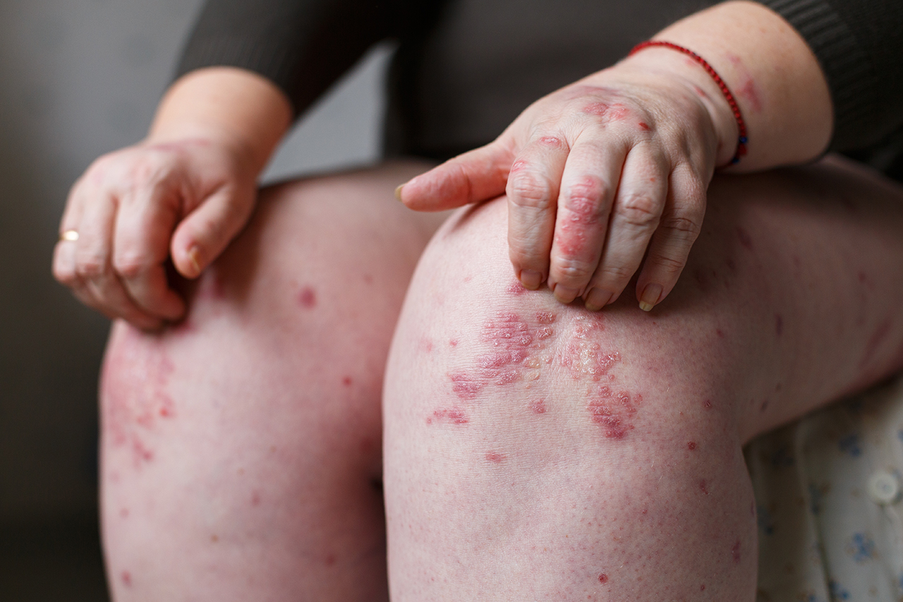 បើ​កូន​មាន​ជំងឺ​សើ​ស្បែក Psoriasis ​ប្រញាប់​ព្យាបាល​ភ្លាម