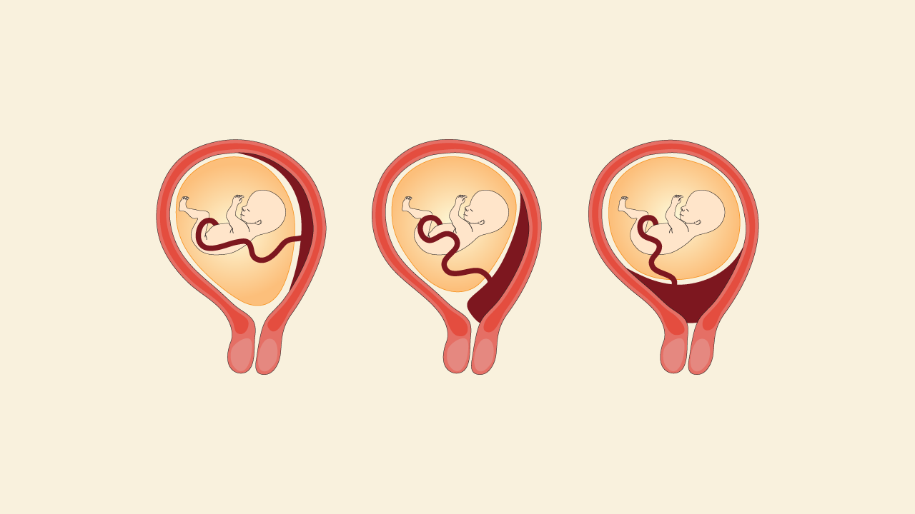 មកដឹងលម្អិតពីករណីសុកពាំងមាត់ស្បូនពេលពពោះ គ្រោះថ្នាក់ខ្លាំងណាស់