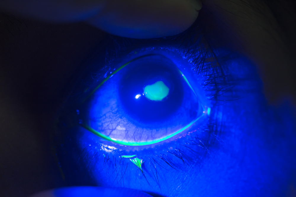 ដំបូងបង្អស់! ជប៉ុន វះកាត់ផ្លាស់ប្ដូរកោសិកា ព្យាបាលជំងឺភ្នែកពីពិការភាព