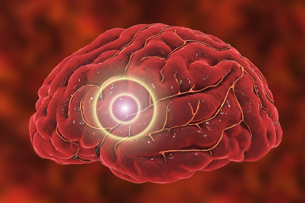 Hemorrhagic stroke (​ជំងឺ​ដាច់សរសៃ​ឈាម​ខួរ​ក្បាល)