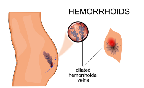 Hemorrhoids (ជំងឺឫសដូង​បាត)
