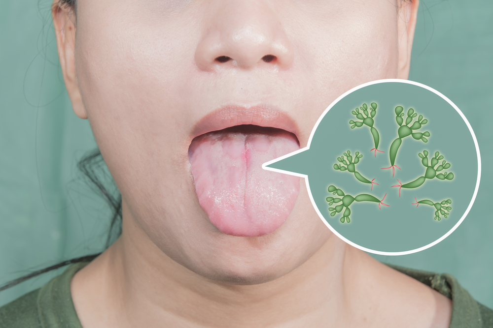 Glossitis (ជំងឺរលាកអណ្ដាត)