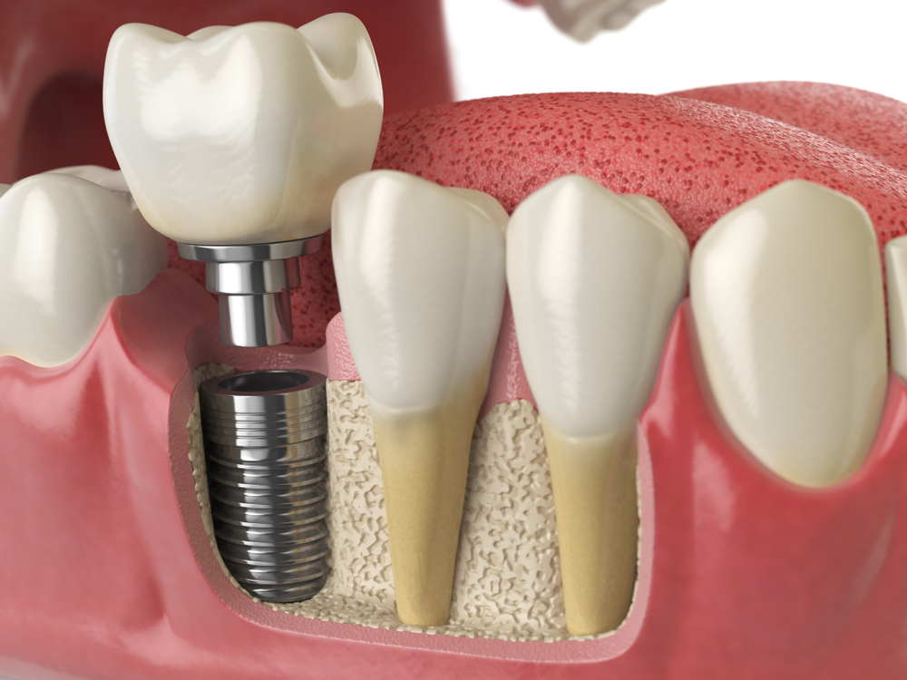 Dental Implant Surgery (វះកាត់​ដាំបង្គោល​ធ្មេញ)