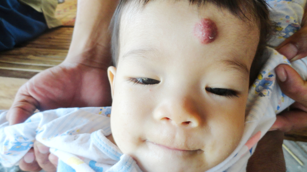 កូនមានស្នាមក្រហមៗដូចដៅបែបនេះ ត្រូវធ្វើបែបណា?