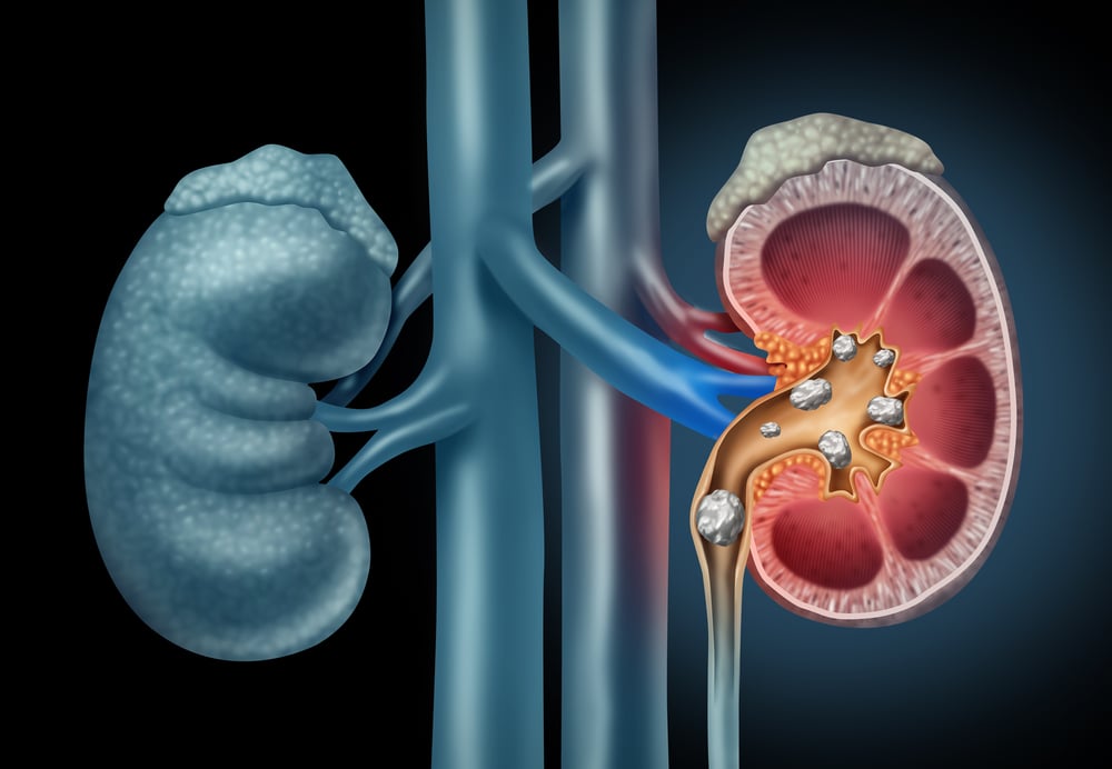 Kidney Stones (ជំងឺ​ក្រួសក្នុង​តម្រង​នោម)