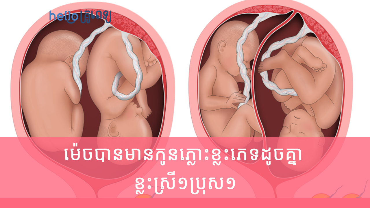 ម៉េចបានមានកូនភ្លោះខ្លះភេទដូចគ្នា ខ្លះស្រី១ប្រុស១ (វីដេអូ)