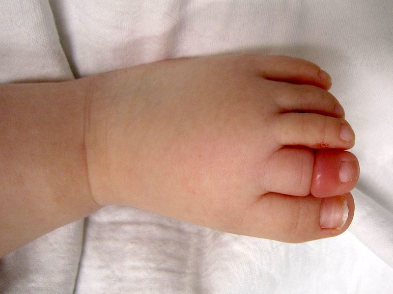 ប្រយ័ត្នម៉ាក់ៗសក់វែង អាចនាំទុក្ខដល់កូនទើបកើត តែរុំដៃជើងកូនយូរ គ្រោះថ្នាក់ដល់កាត់ម្រាមចោល