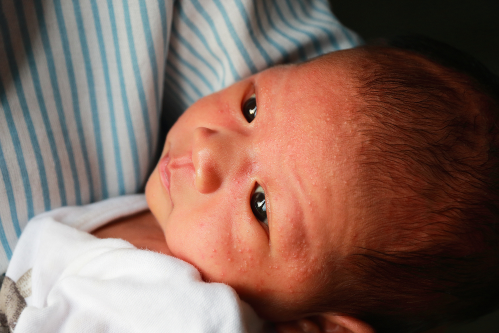 កូនទើបកើតពាក់មួក ឬឃ្លុំជិតៗពេក ស្បែកថ្ងាសអាចជួបបញ្ហាបែបនេះ