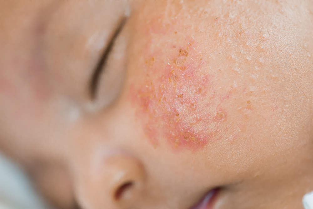 ទារករលាកស្បែកមុខ ទៅជាគ្រើម ឡើងពណ៌ក្រហមៗ អាចមកពីបញ្ហាប៉ុន្មាននេះ