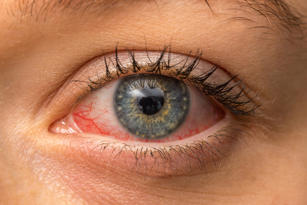 ធ្វើម៉េចដឹងថាកំពុងឈឺភ្នែក ឬភ្នែកមានអាលែកហ្ស៊ី?