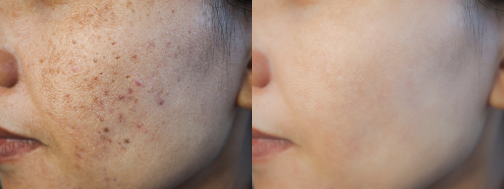 កម្ចាត់​បញ្ហា​ស្នាម​មុន​លើ​ផ្ទៃ​មុខ​ ជាមួយ​នឹង​អាហារ​ ​៥​ប្រភេទនេះ​​​​​​​​​​​​​​​​​​​​​​​​​​​​​​​​​​​​​​​​​​​​