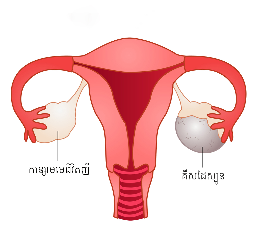 ធ្វើម៉េចដឹងថាគីសដៃស្បូនជាគីសធម្មតា ឬគីសត្រូវព្យាបាល?