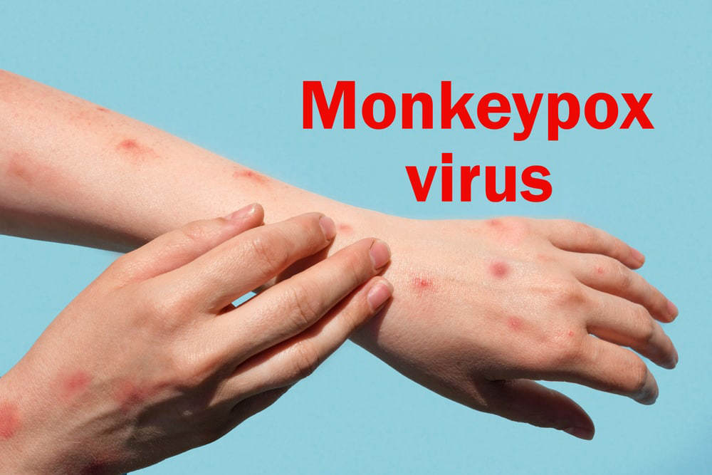 អ្នក​ជំងឺ​អុតស្វា​​​គ្មាន​រោគសញ្ញា​ ​អាច​ចម្លង​ទៅ​អ្នក​ផ្សេង​​បាន​អត់?