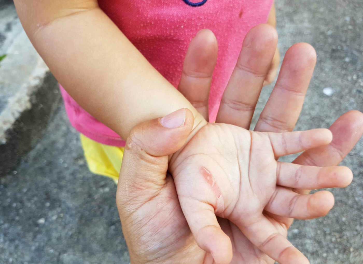 ក្មេងរលាកភ្លើង ឬទឹកក្តៅ ប៉ាម៉ាក់ត្រូវធ្វើបែបណា? ​​​​​​​​​​​​​​​​​​​​​​​​​​​​​​​​​​​​​​​​