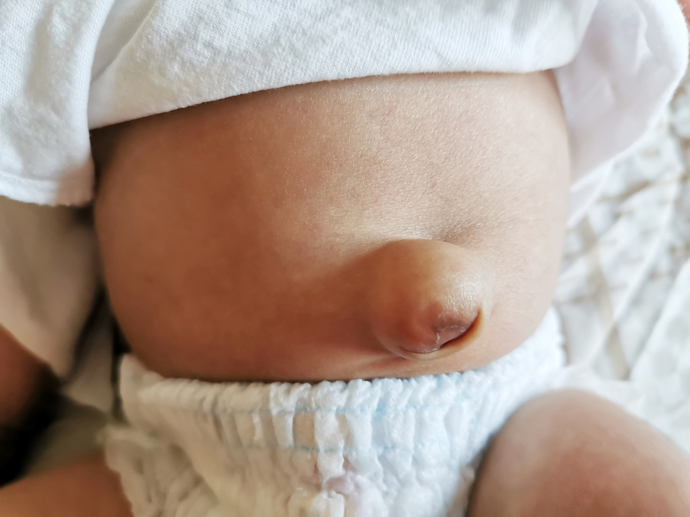 ម៉េចទារកទើបកើតខ្លះមានបញ្ហាផ្ចិតលៀន? អាចបាត់ទៅវិញអត់?