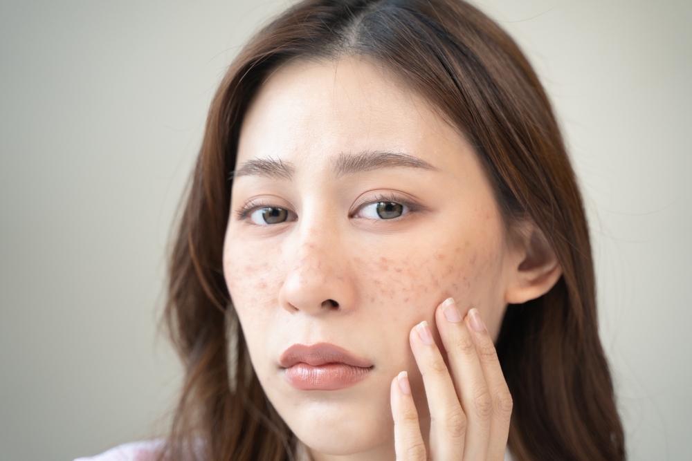 ប្រជ្រុយបែកសាច់ ឬSolar Lentigoគ្រោះថ្នាក់អត់? បង្ការបែបណា?